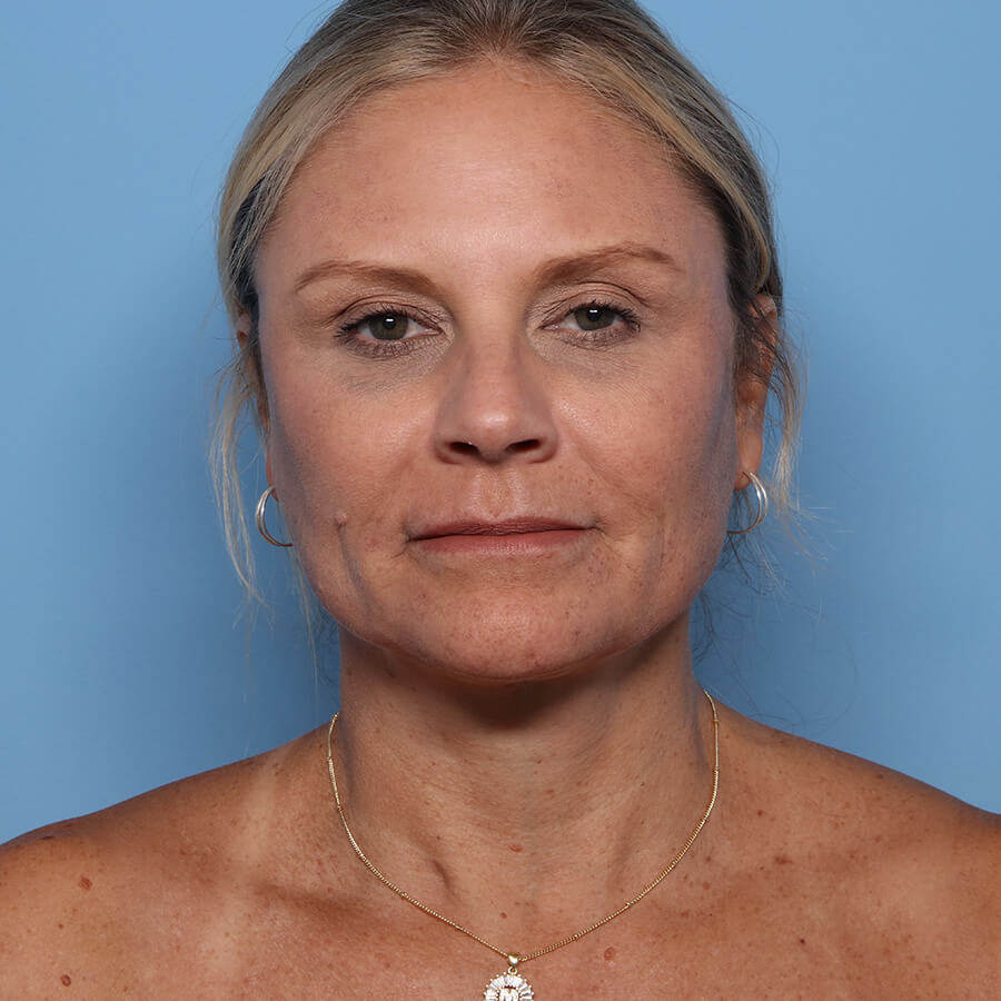 Case--26024 | After Neck Lift