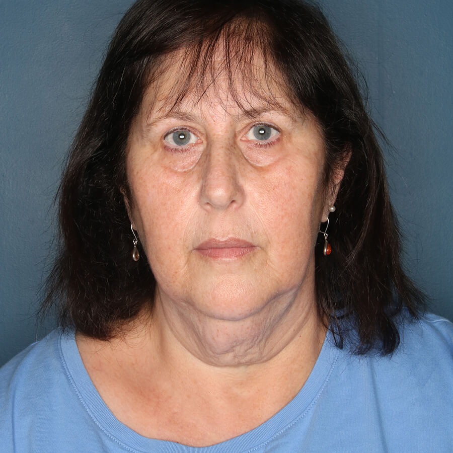 Case--26124 | Before Neck Lift