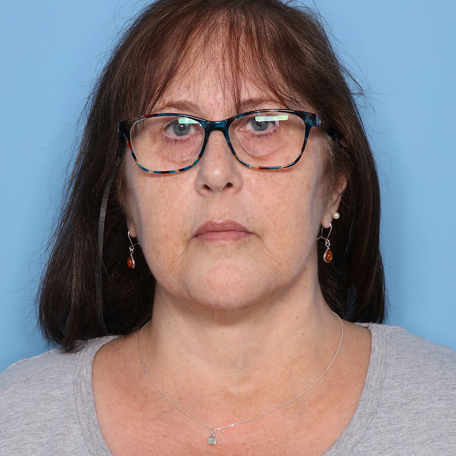 Case--26124 | After Neck Lift