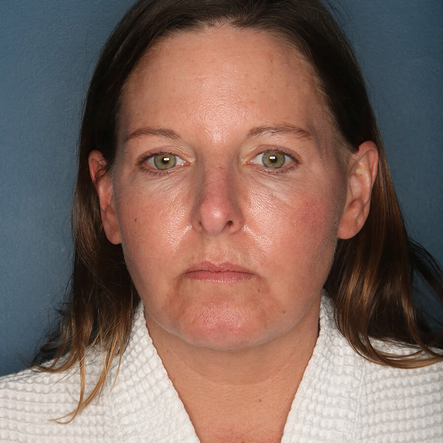 Case--26224 | Before Neck Lift