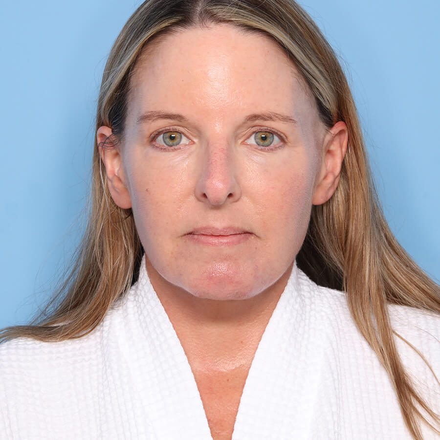 Case--26224 | After Neck Lift