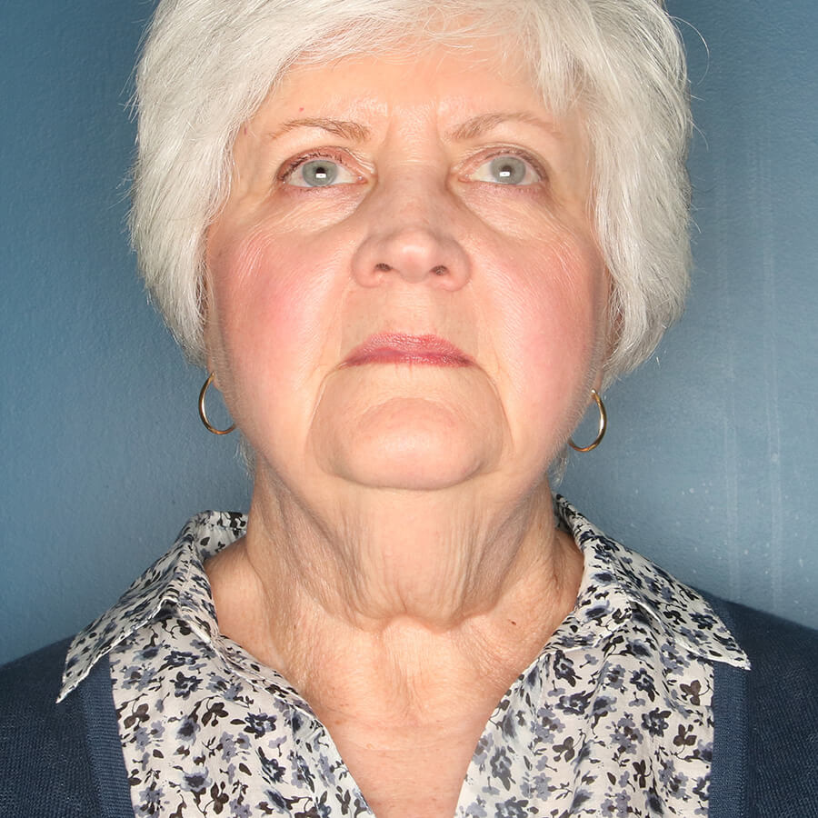 Case--26324 | Before Neck Lift