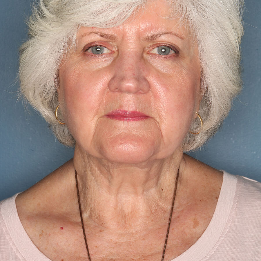 Case--26324 | After Neck Lift