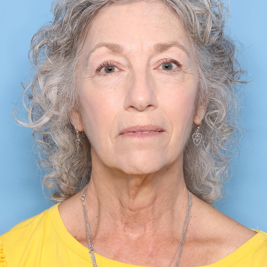 Case--26624 | Before Neck Lift