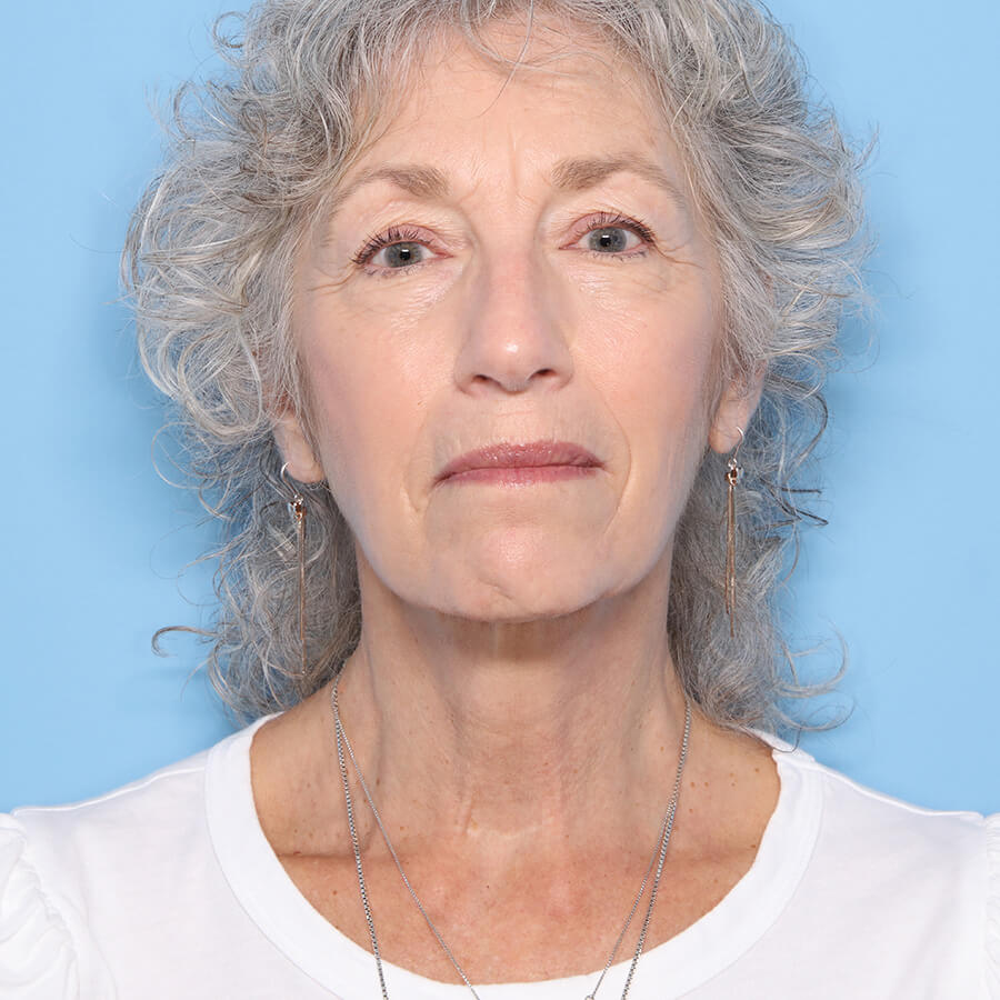 Case--26624 | After Neck Lift