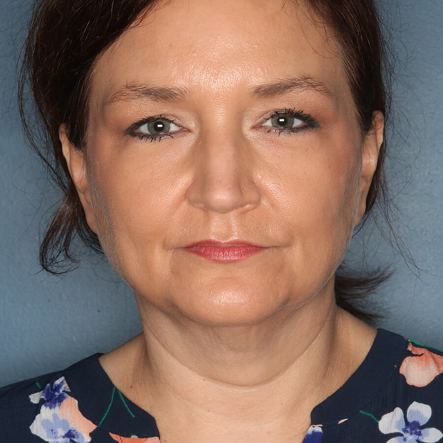 Case--26724 | Before Neck Lift