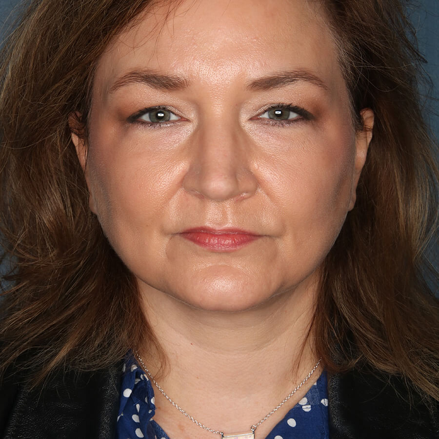 Case--26724 | After Neck Lift