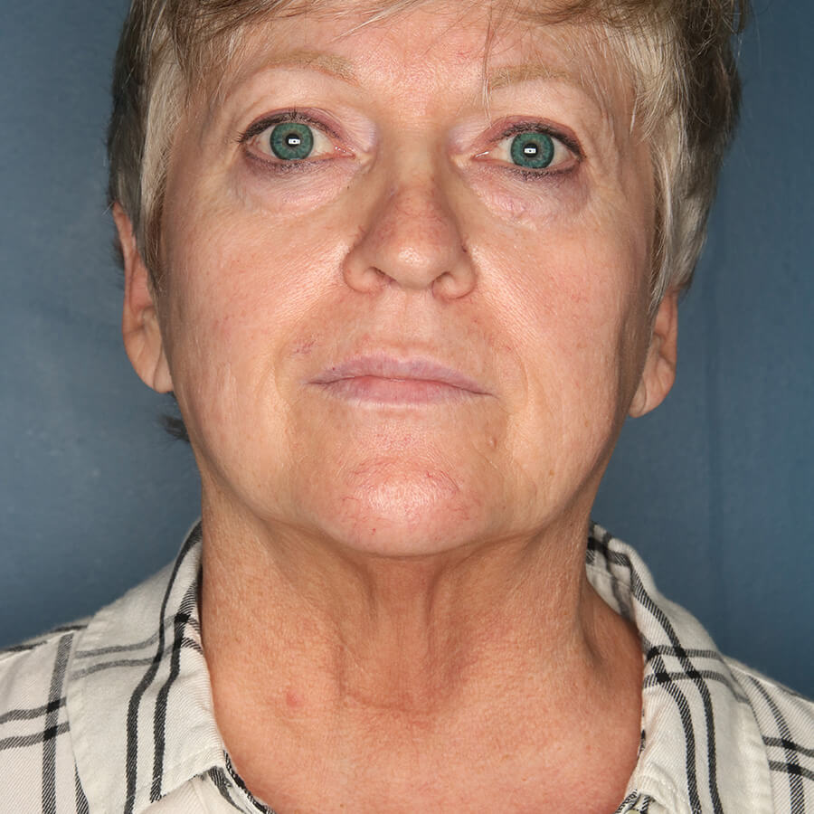 Case--26924 | Before Neck Lift