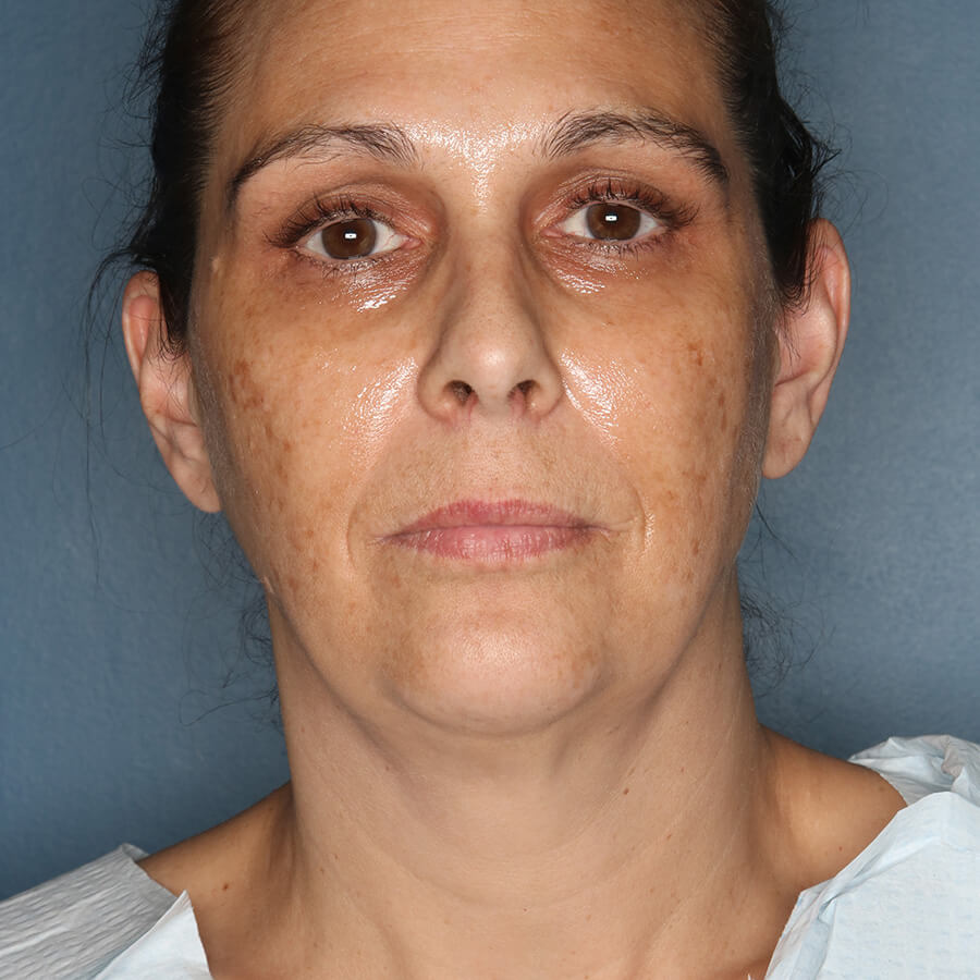 Case--27224 | Before Neck Lift