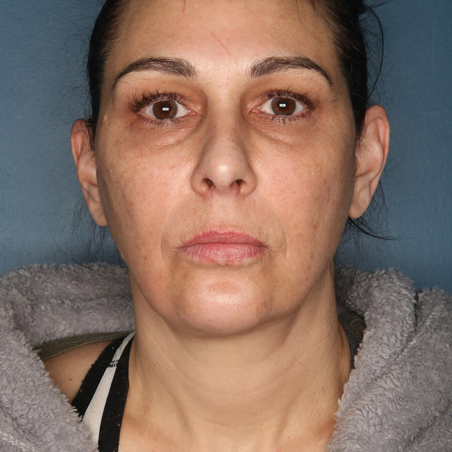 Case--27224 | After Neck Lift