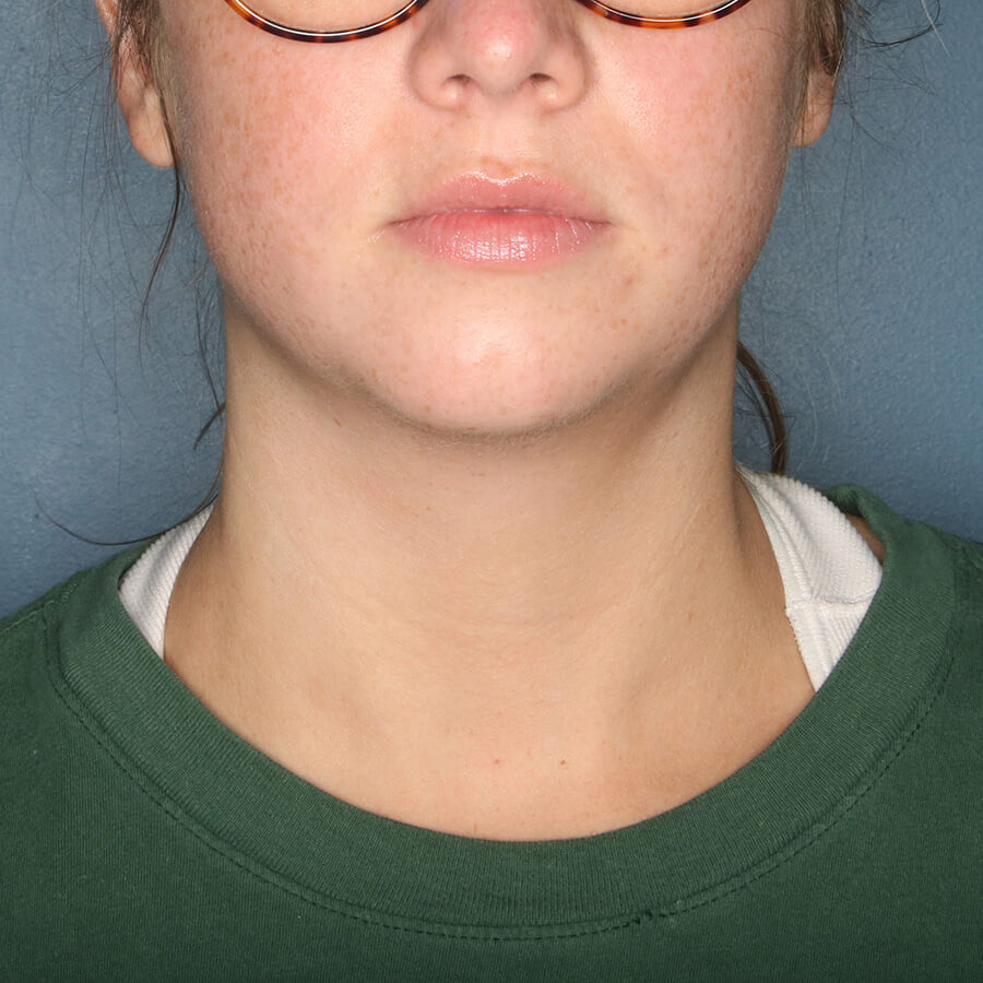 Case--27324 | Before Submental Liposuction (Neck Liposuction)