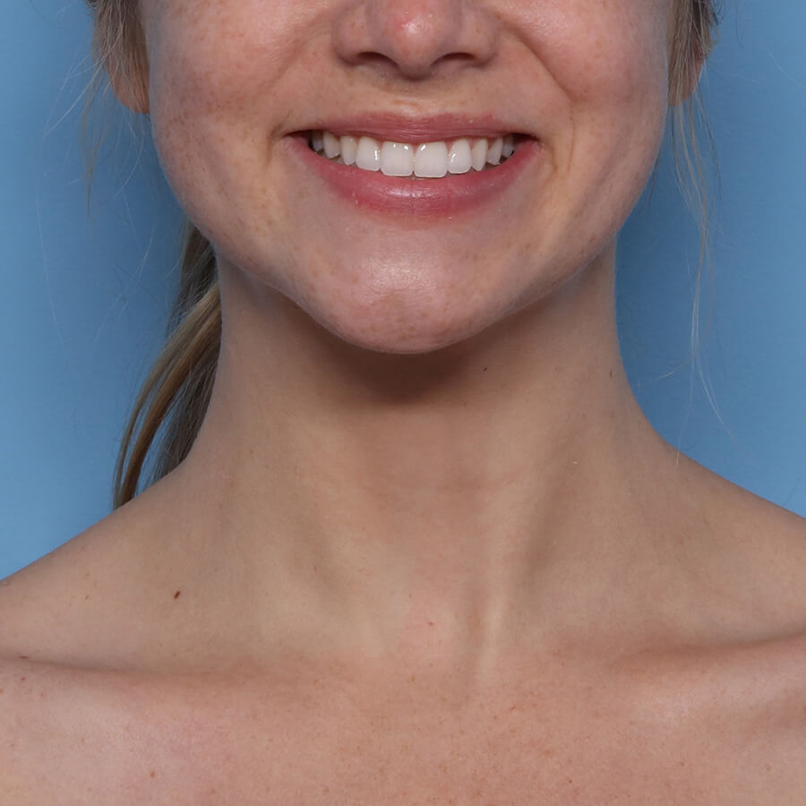 Case--27324 | After Submental Liposuction (Neck Liposuction)