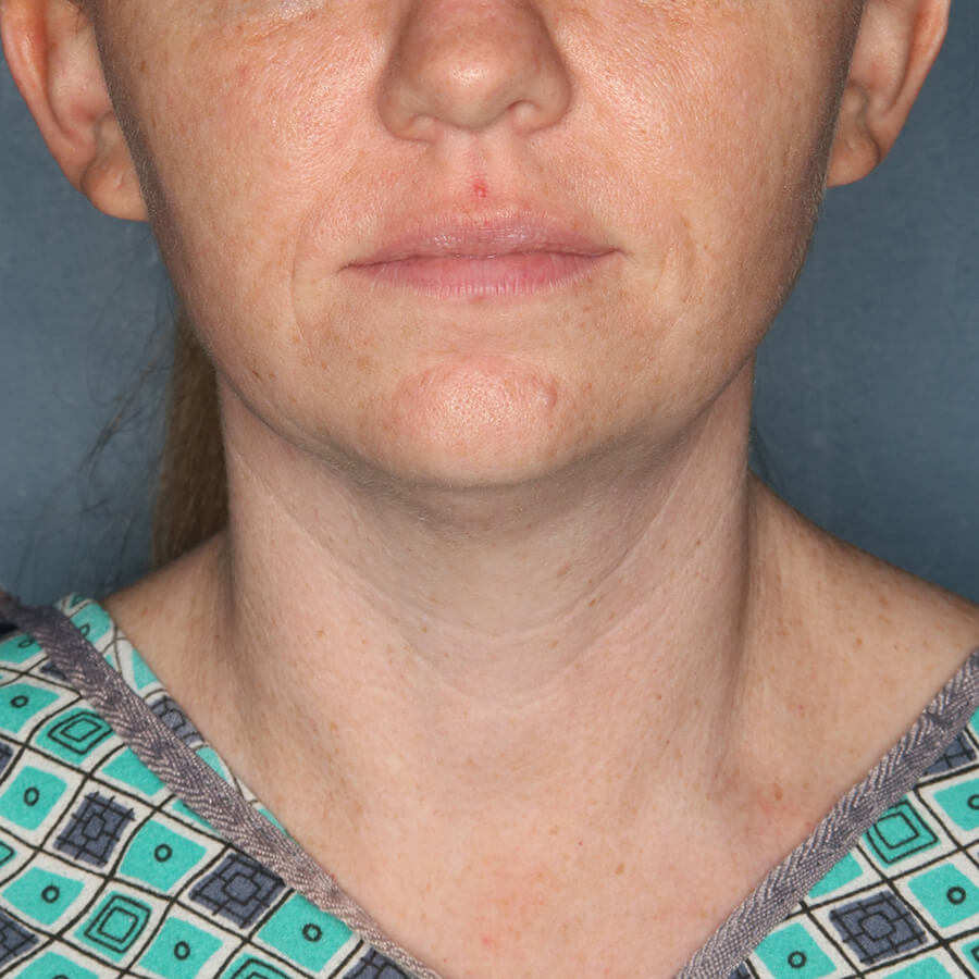 Case--27424 | Before Submental Liposuction (Neck Liposuction)