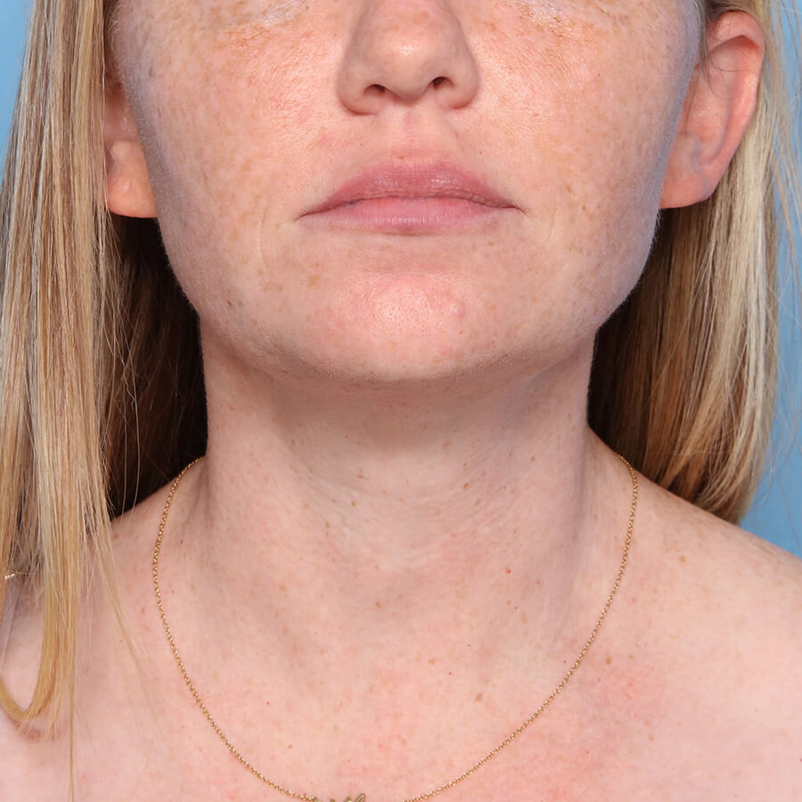 Case--27424 | After Submental Liposuction (Neck Liposuction)
