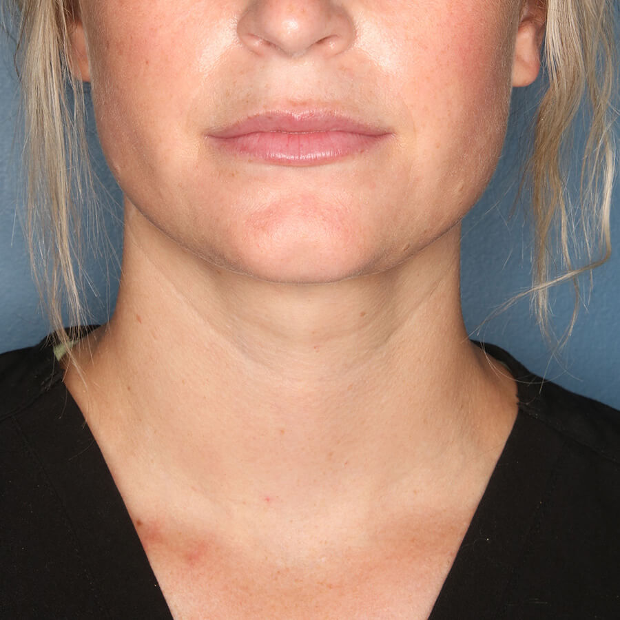 Case--27524 | After Submental Liposuction (Neck Liposuction)
