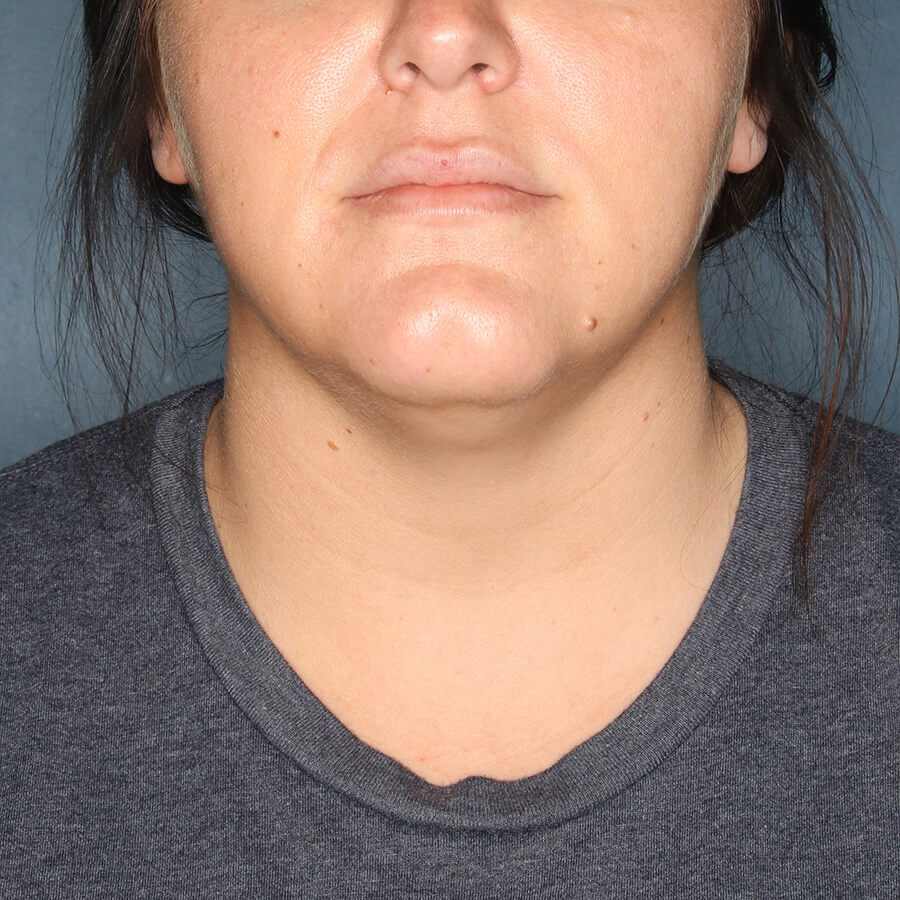 Case--27724 | Before Submental Liposuction (Neck Liposuction)