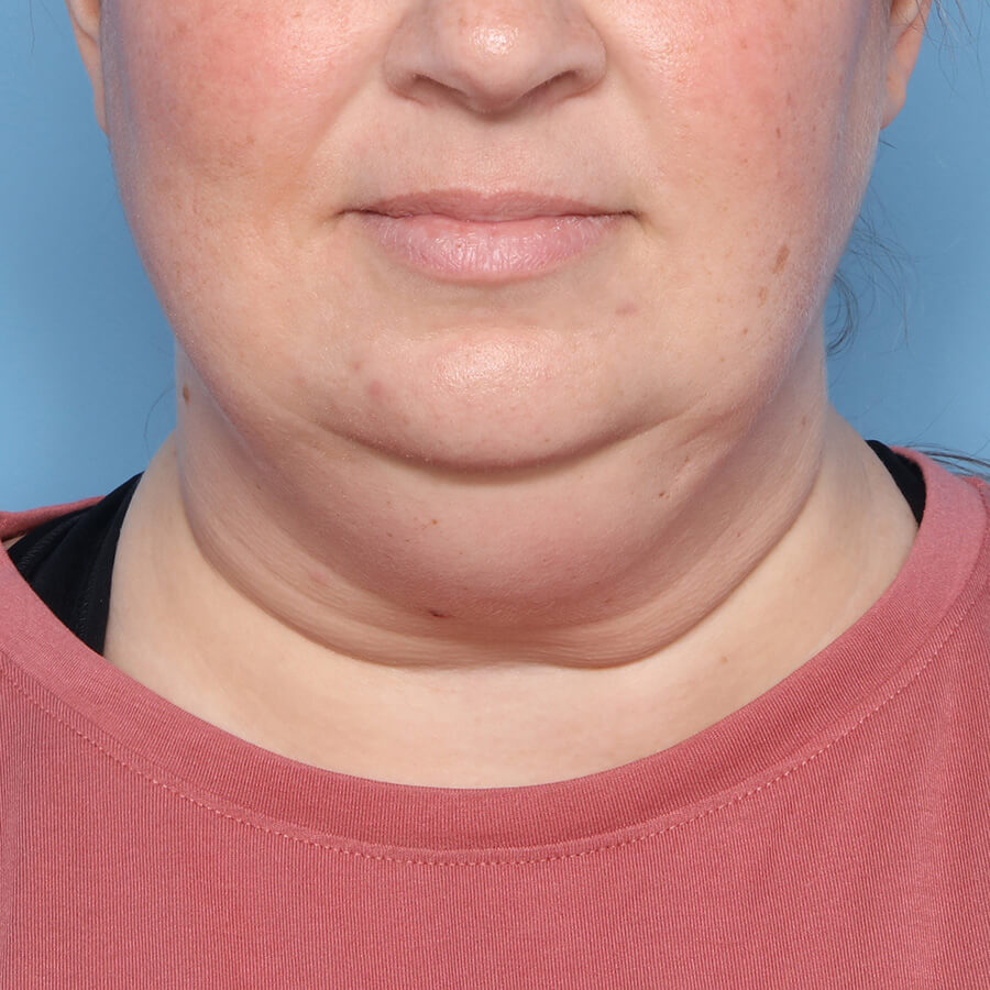 Case--27824 | Before Submental Liposuction (Neck Liposuction)