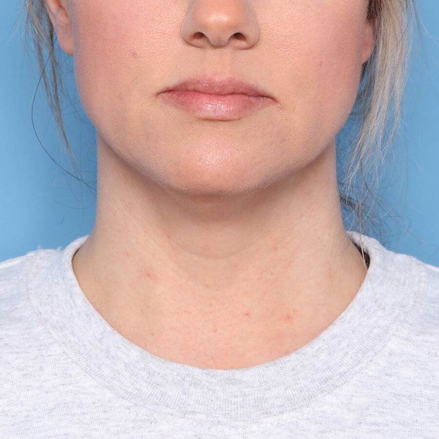 Case--27924 | Before Submental Liposuction (Neck Liposuction)