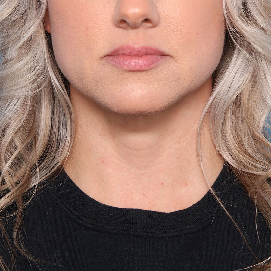 Case--27924 | After Submental Liposuction (Neck Liposuction)