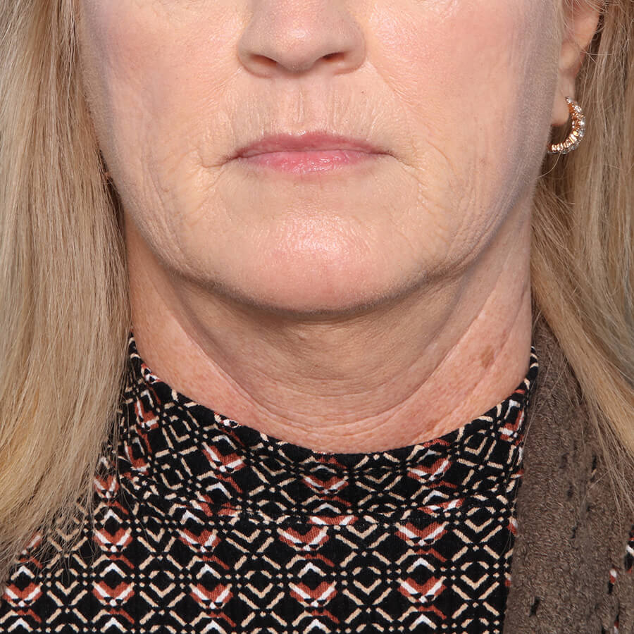 Case--28024 | Before Submental Liposuction (Neck Liposuction)