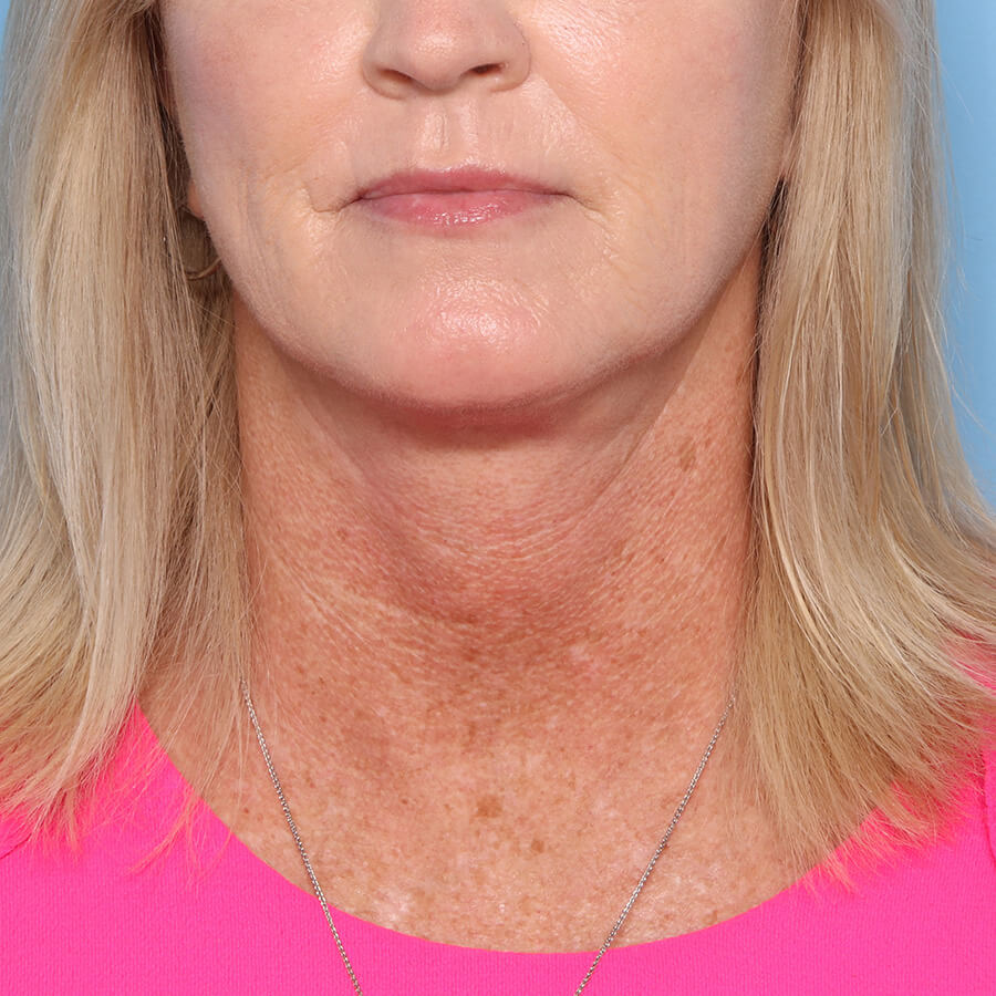 Case--28024 | After Submental Liposuction (Neck Liposuction)