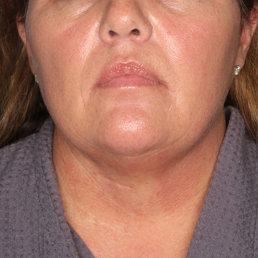 Case--28224 | Before Submental Liposuction (Neck Liposuction)