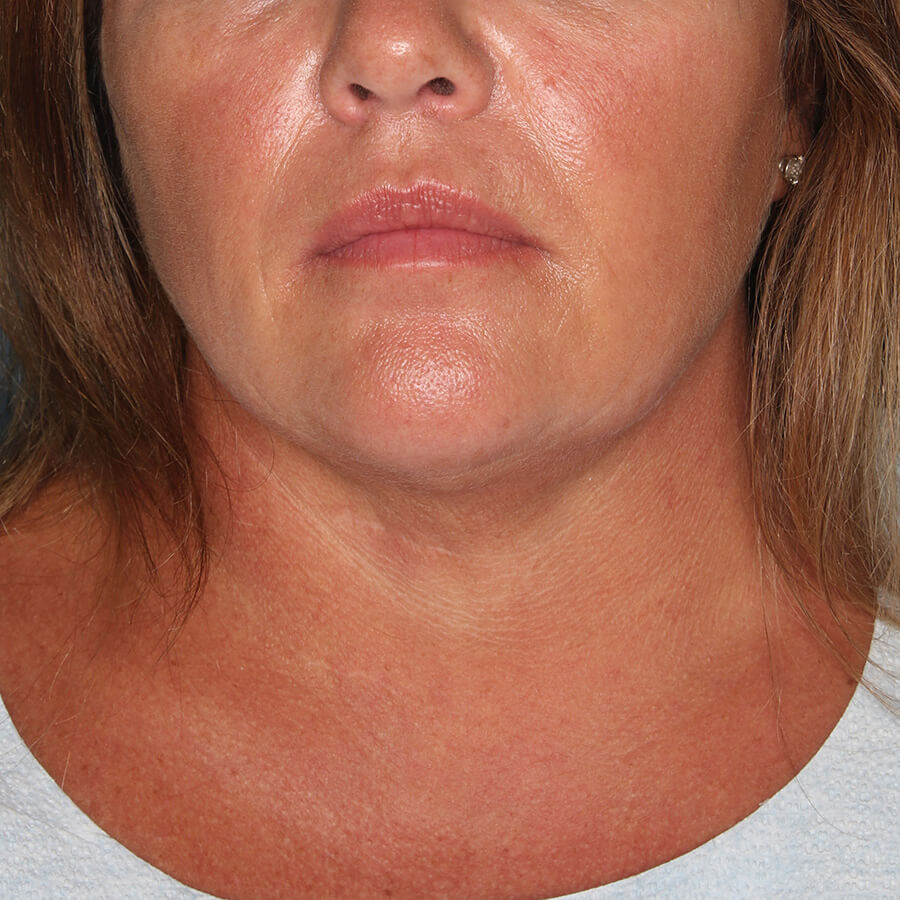 Case--28224 | After Submental Liposuction (Neck Liposuction)
