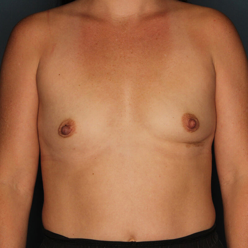Case--2824 | Before Cosmetic Breast Surgery
