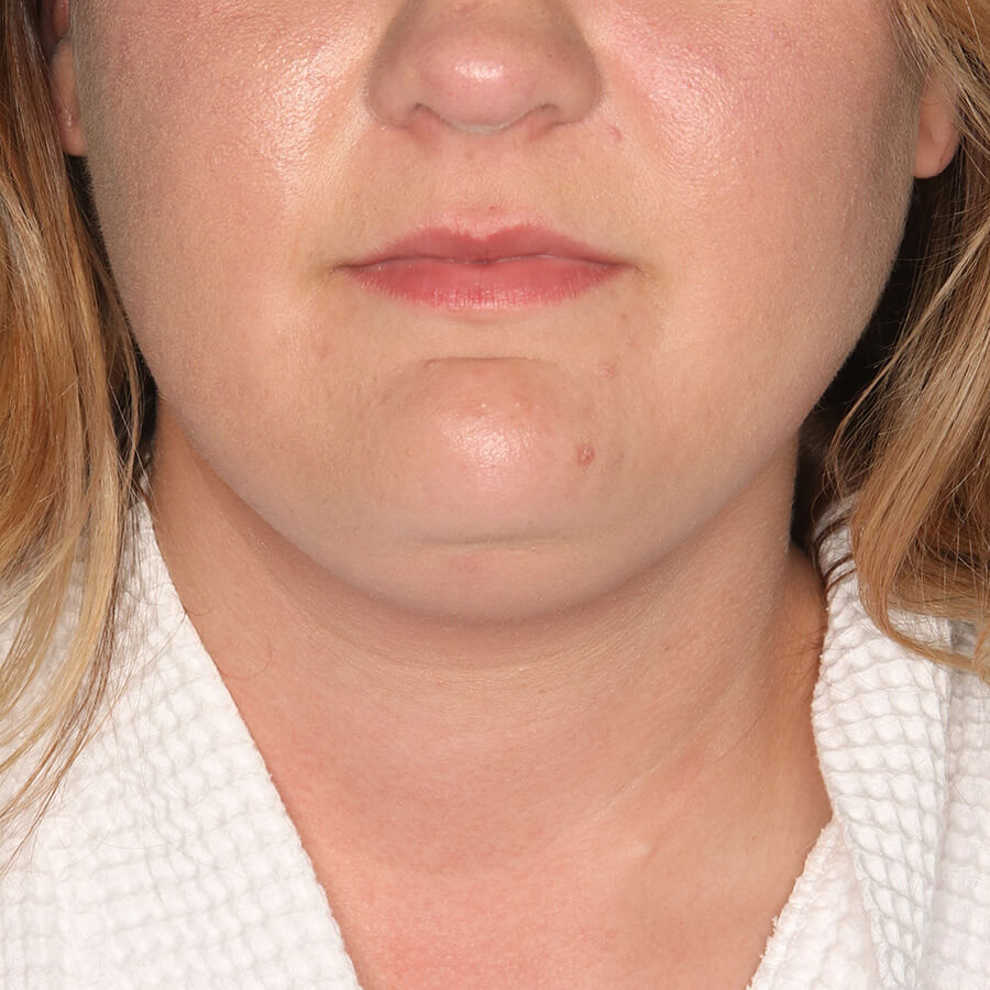 Case--28424 | Before Submental Liposuction (Neck Liposuction)