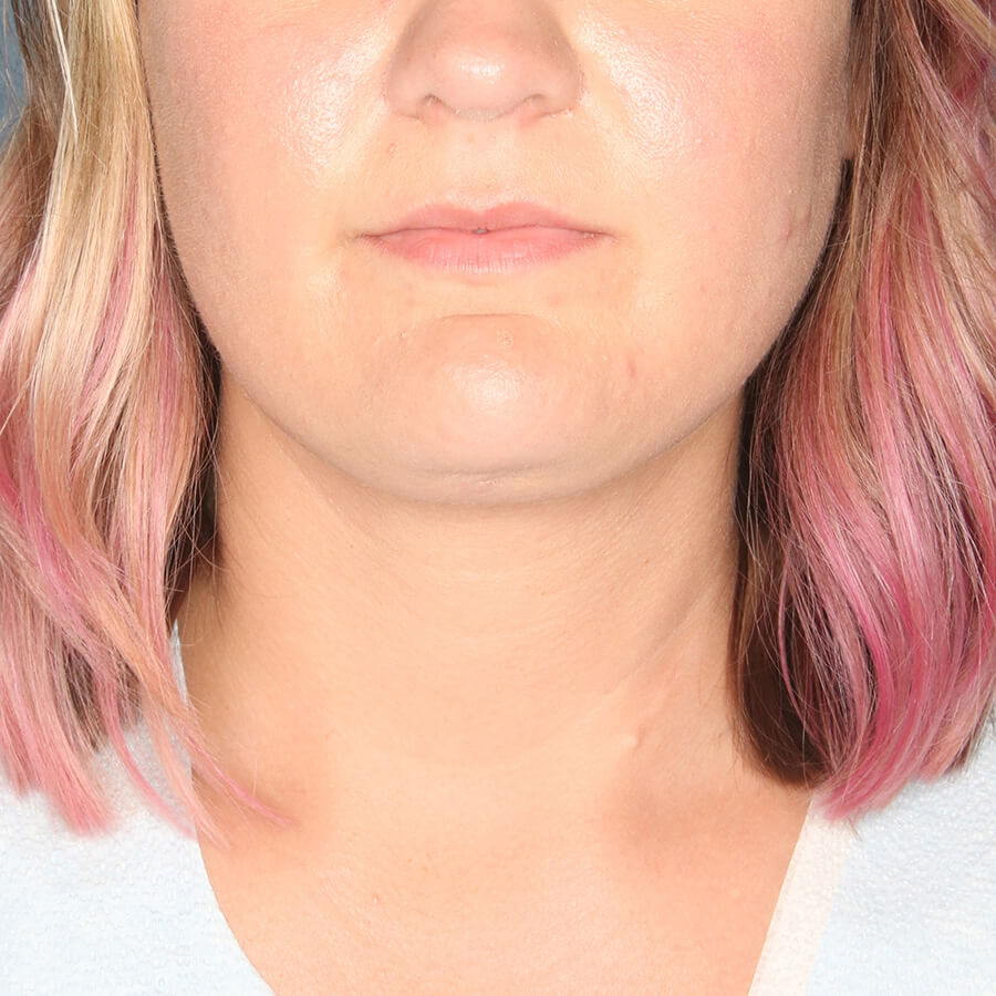 Case--28424 | After Submental Liposuction (Neck Liposuction)