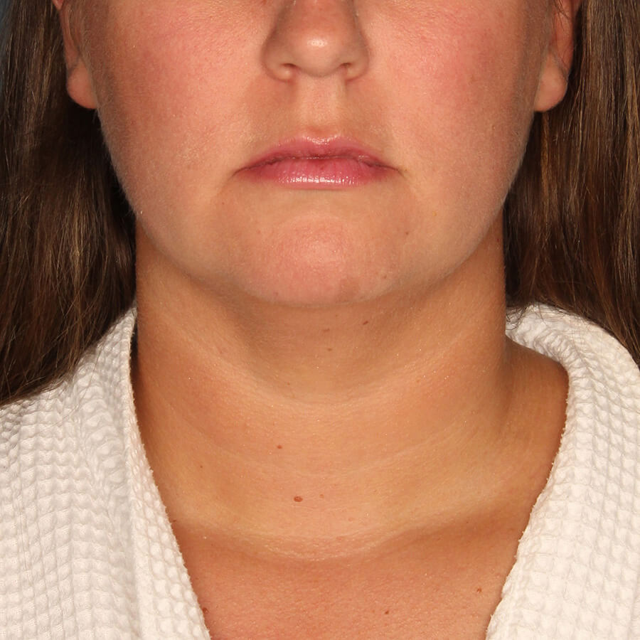 Case--28524 | Before Submental Liposuction (Neck Liposuction)