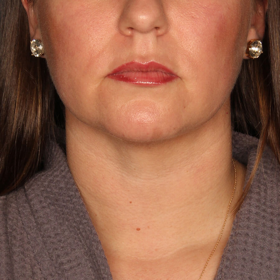 Case--28524 | After Submental Liposuction (Neck Liposuction)