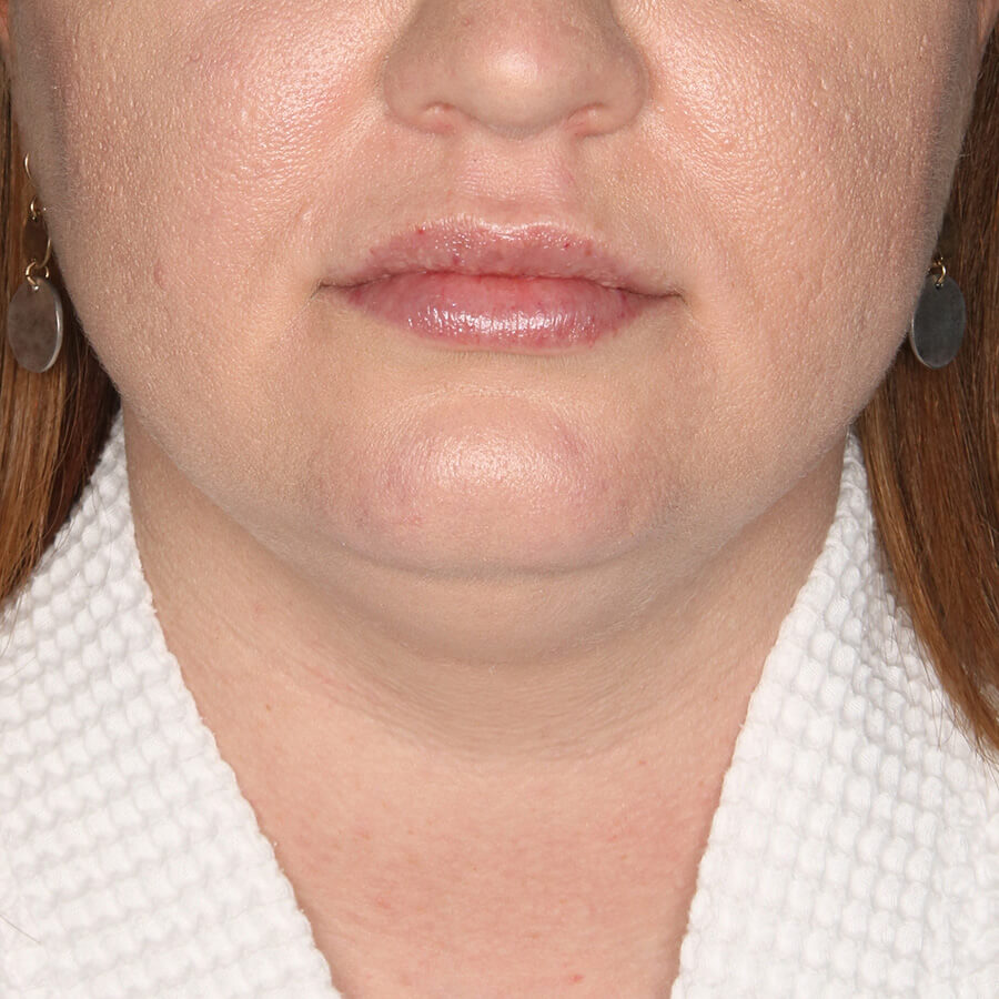 Case--28624 | Before Face