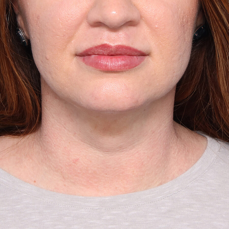 Case--28624 | After Face