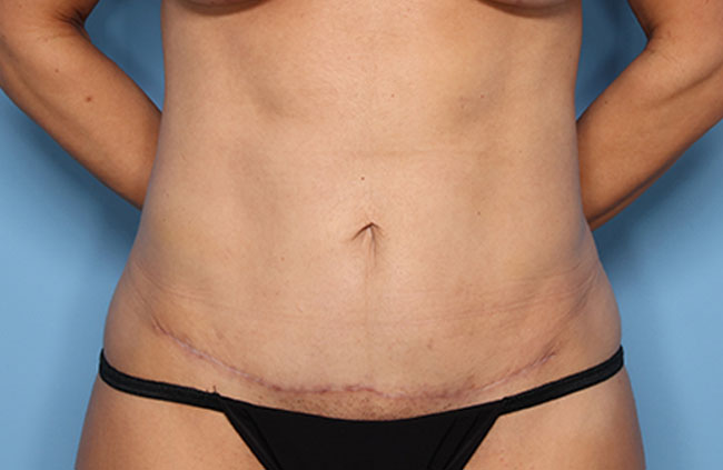 Case--28724 | After Mini Abdominoplasty