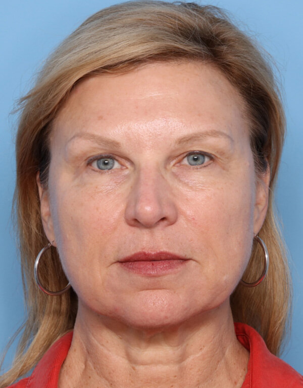 Patient-3123 | Before Facelift