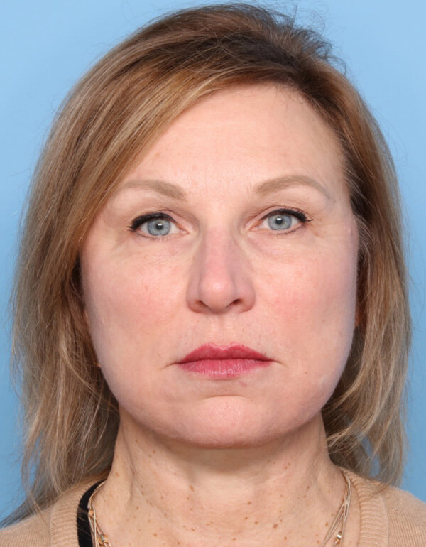 Patient-3123 | After Facelift