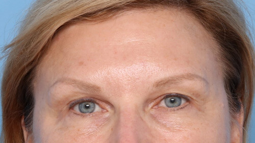 Patient-3233 | Before Face