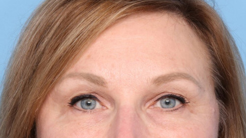 Patient-3233 | After Face