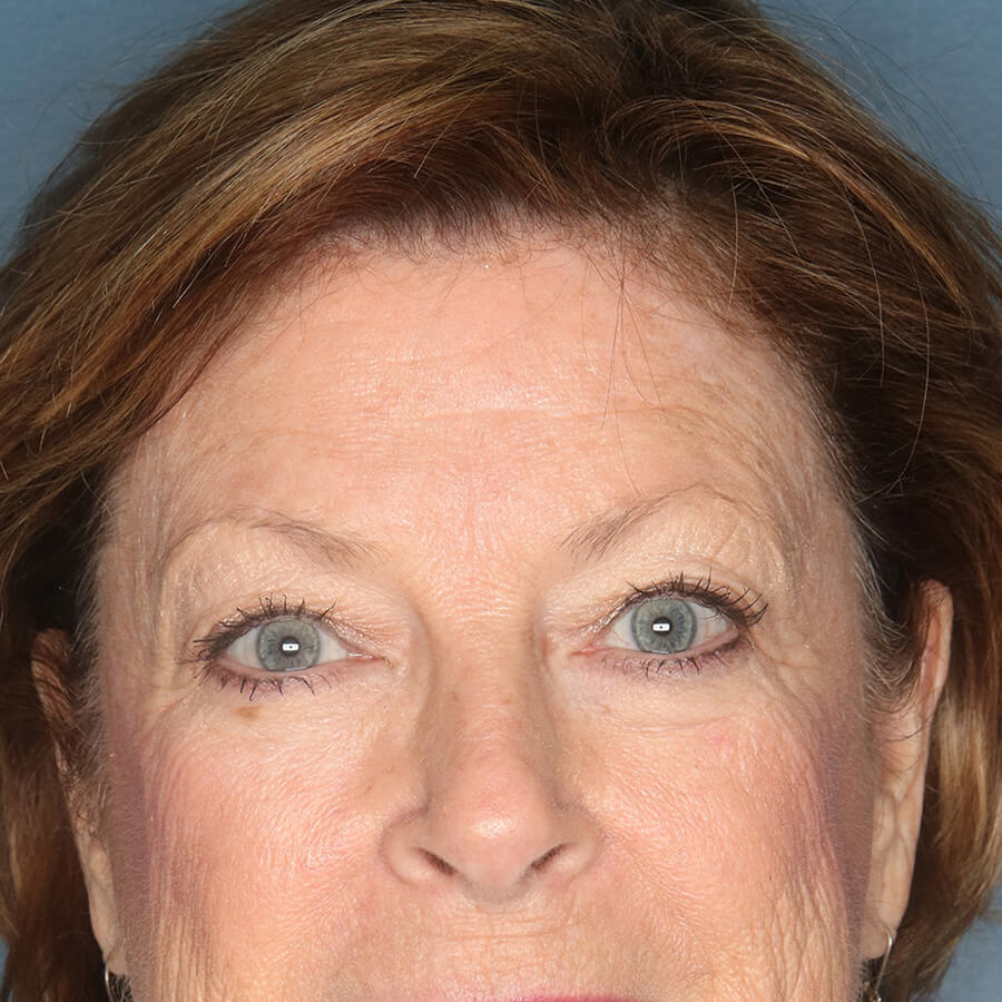 Case--32524 | Before Blepharoplasty