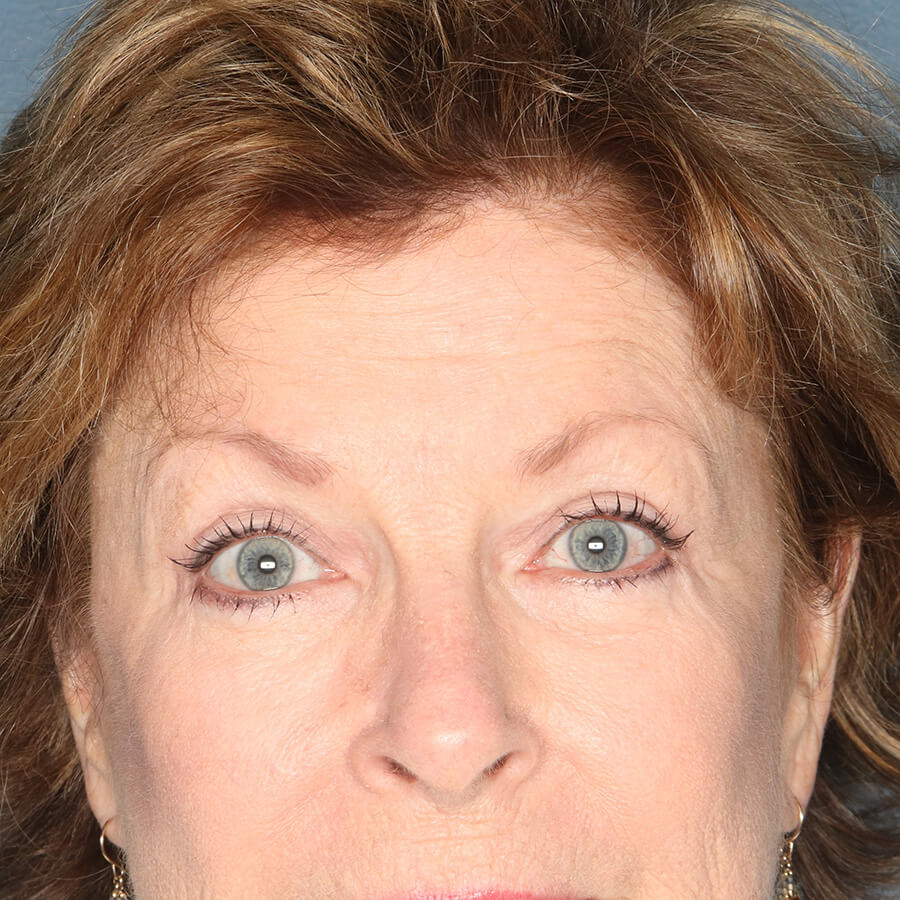 Case--32524 | After Blepharoplasty