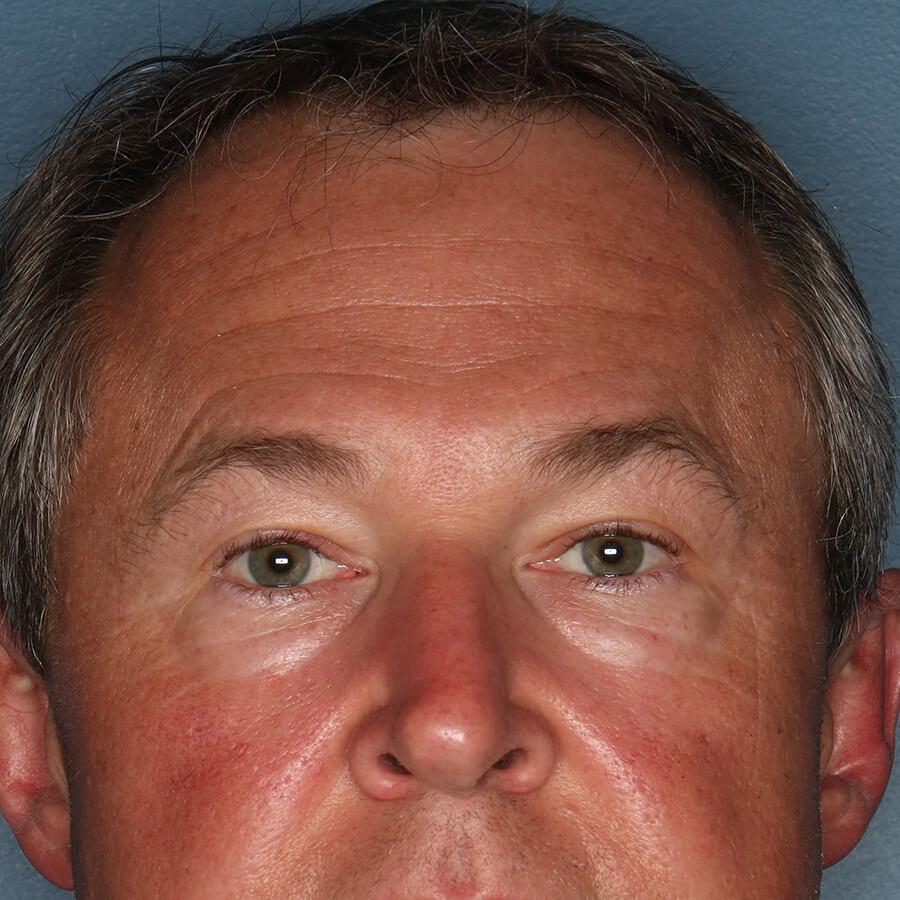 Case--32624 | Before Blepharoplasty