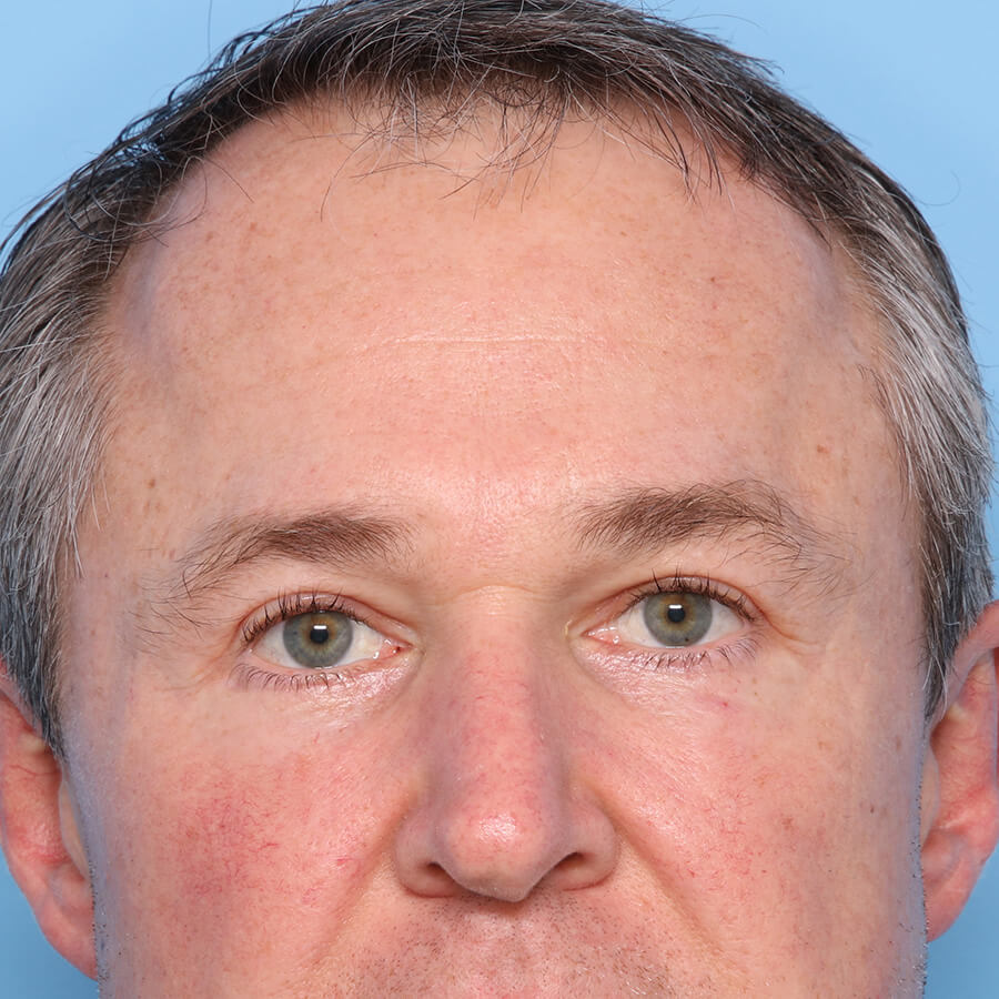 Case--32624 | After Blepharoplasty