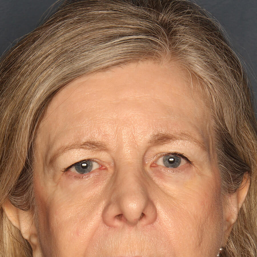 Case--32724 | Before Blepharoplasty