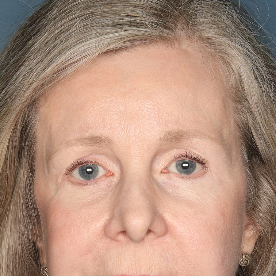 Case--32724 | After Blepharoplasty