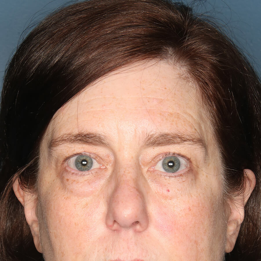 Case--32824 | Before Blepharoplasty