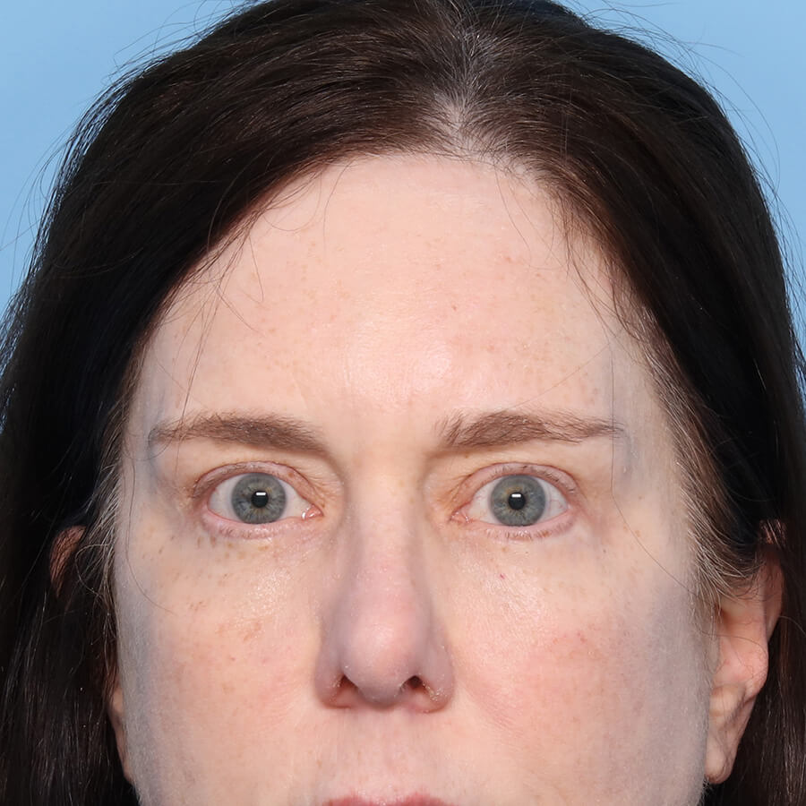Case--32824 | After Blepharoplasty