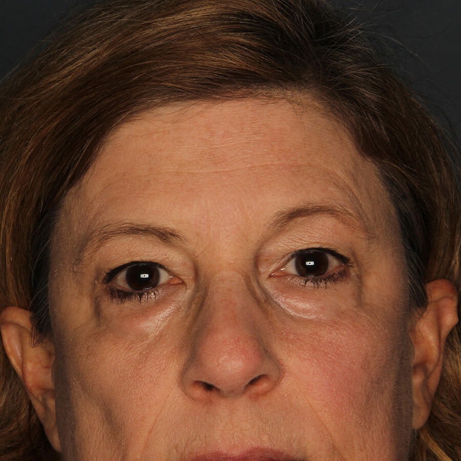 Case--33024 | Before Blepharoplasty