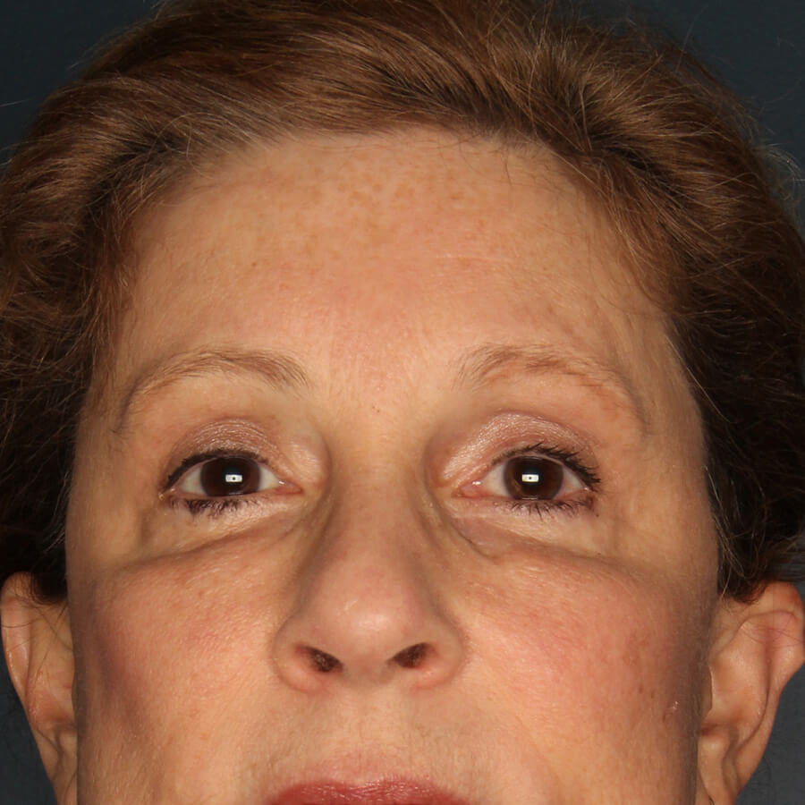 Case--33024 | After Blepharoplasty