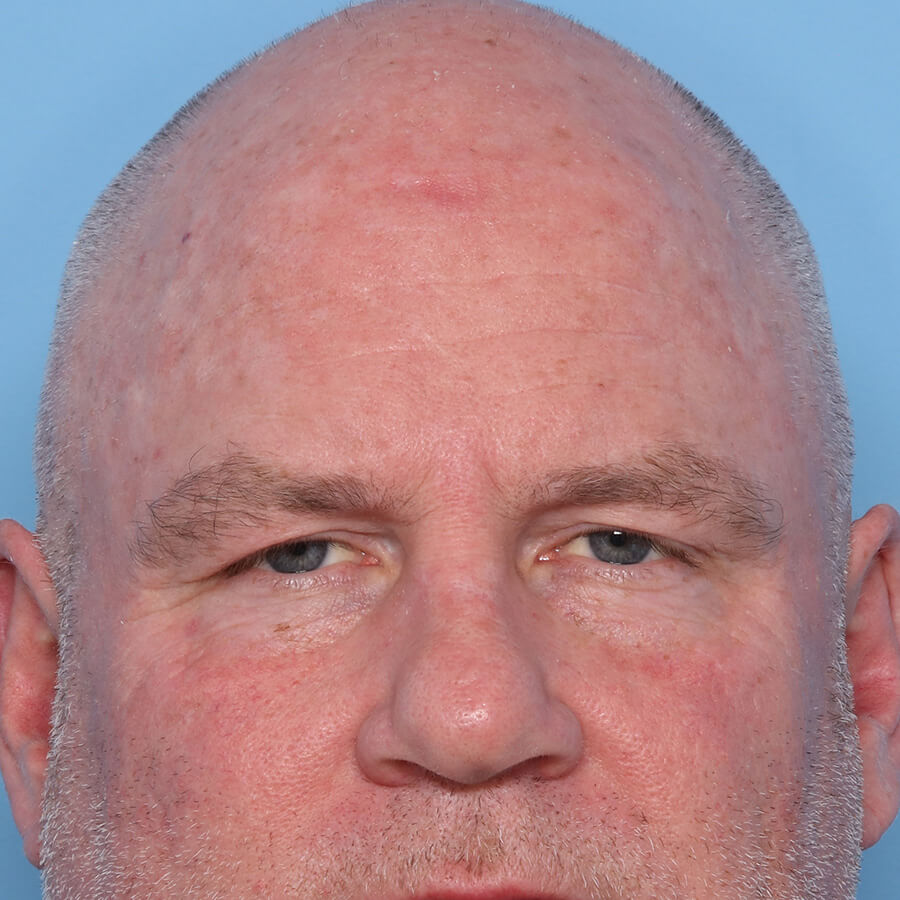 Case--33124 | Before Blepharoplasty